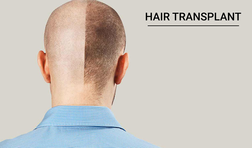 Hair Transplant in Udaipur